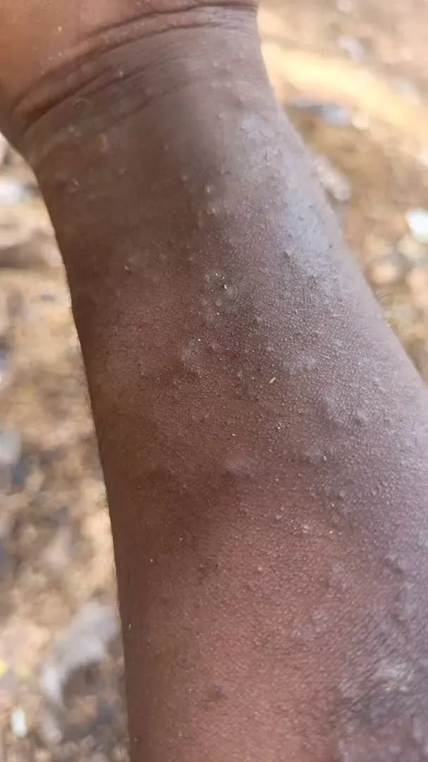 🛑 STOP AUX BOUTONS SUR LE VISAGE ET LE CORPS ! 🛑