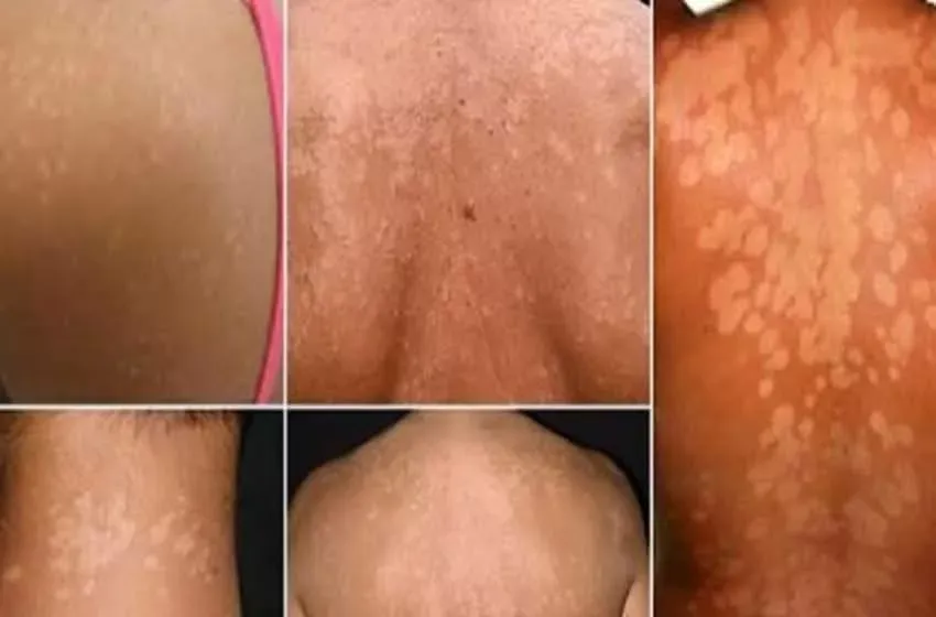 🛑STOP AUX DARTRES SUR LE VISAGE ET LE CORPS !🛑