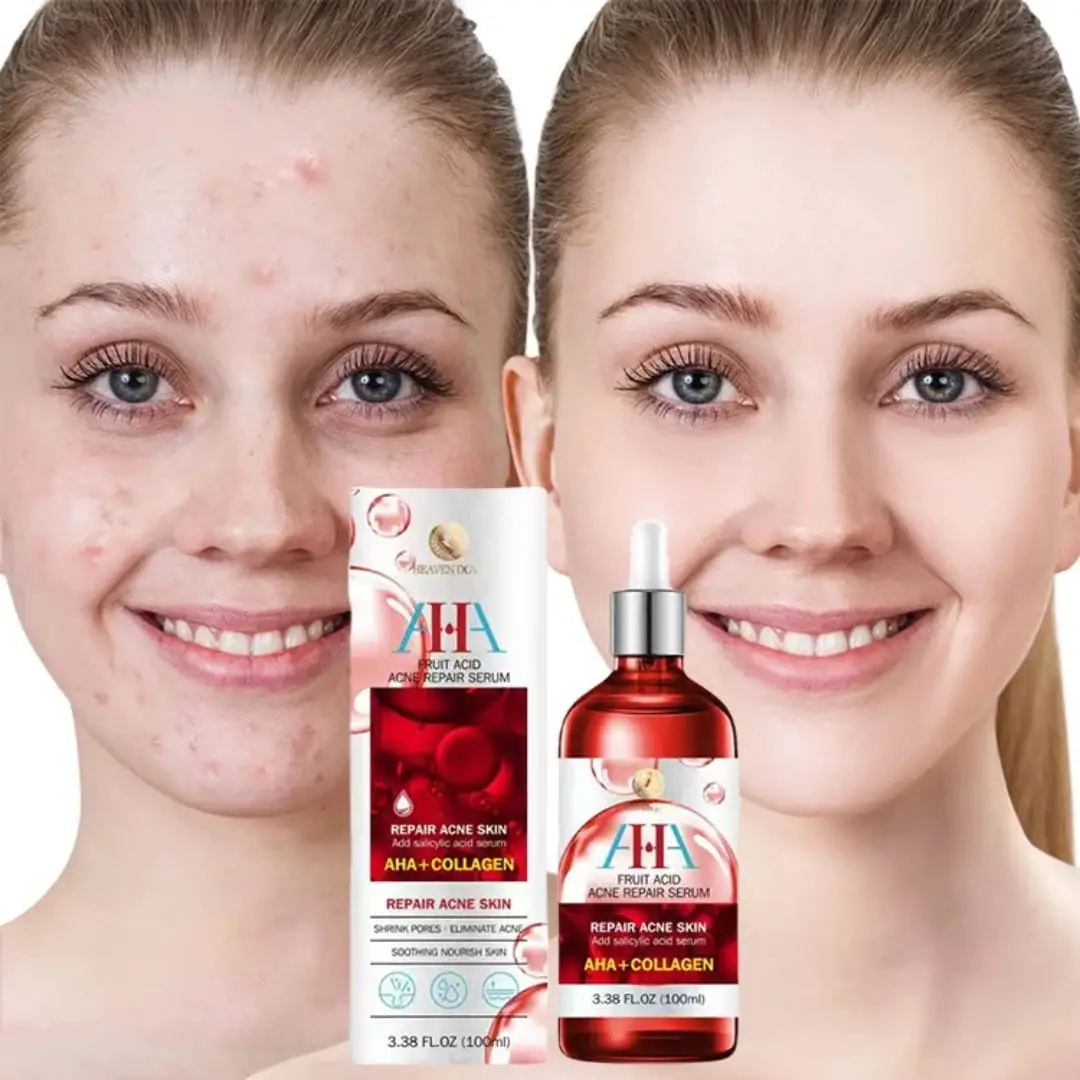 Sérum AHA Anti-Acné (100 ml)