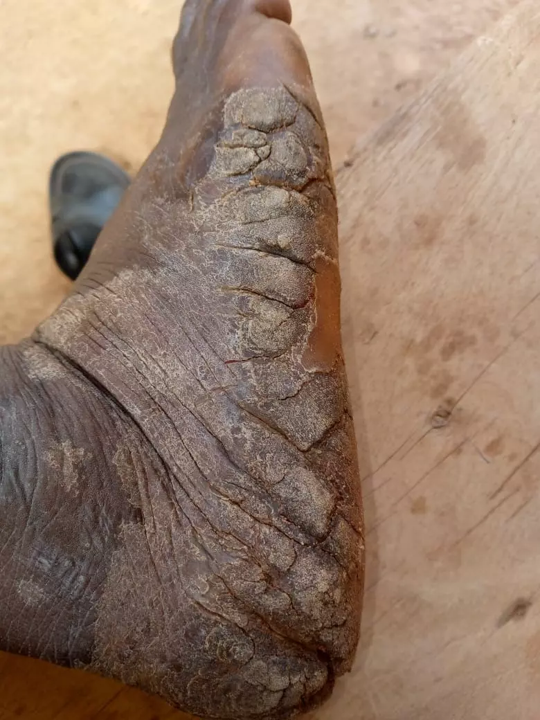 🛑FINI LES TALONS SECS ET NOIRS AVEC CE SAVON 100% NATUREL – LIVRAISON À BAMAKO 🛑 - Vue détaillée 3