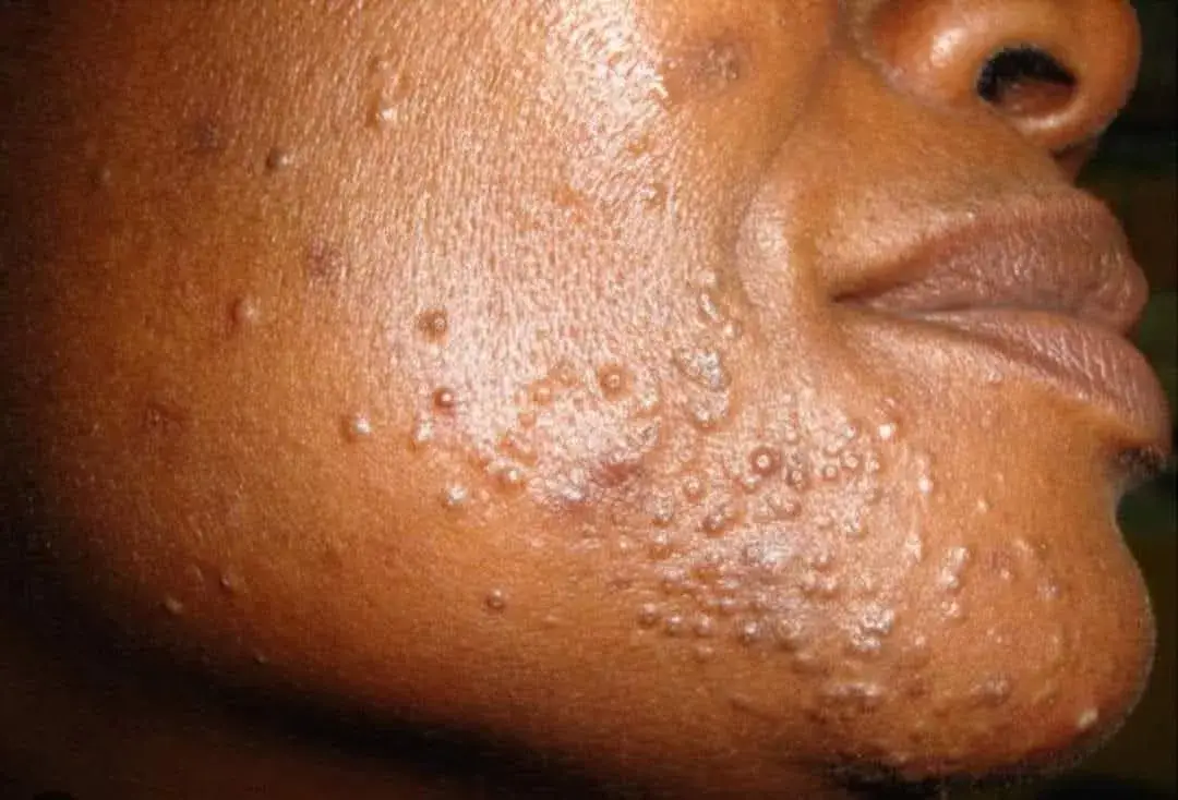 Vue alternative 1 - ? STOP AUX BOUTONS SUR LE VISAGE ET LE CORPS ! ?