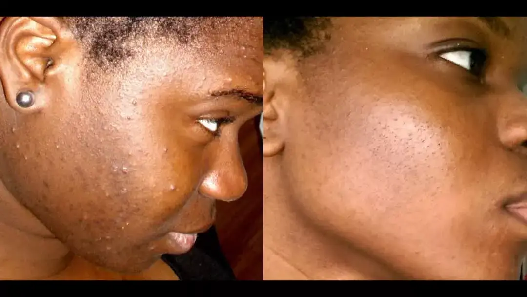 Vue alternative 1 - ? STOP AUX BOUTONS SUR LE VISAGE ET LE CORPS ! ?