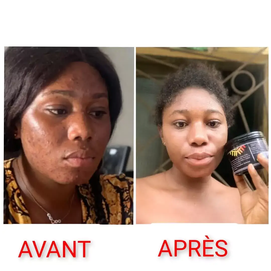 Vue alternative 2 - ? STOP AUX BOUTONS SUR LE VISAGE ET LE CORPS ! ?