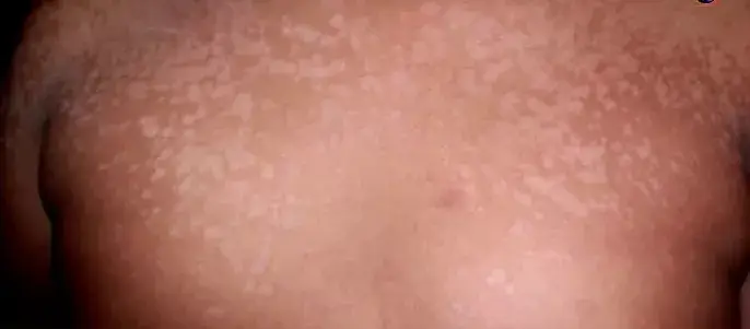Vue alternative 3 - ?STOP AUX DARTRES SUR LE VISAGE ET LE CORPS !?