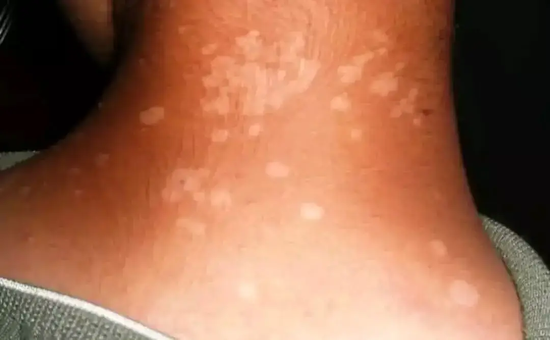 Vue alternative 2 - ?STOP AUX DARTRES SUR LE VISAGE ET LE CORPS !?