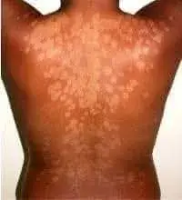 Vue alternative 1 - ?STOP AUX DARTRES SUR LE VISAGE ET LE CORPS !?