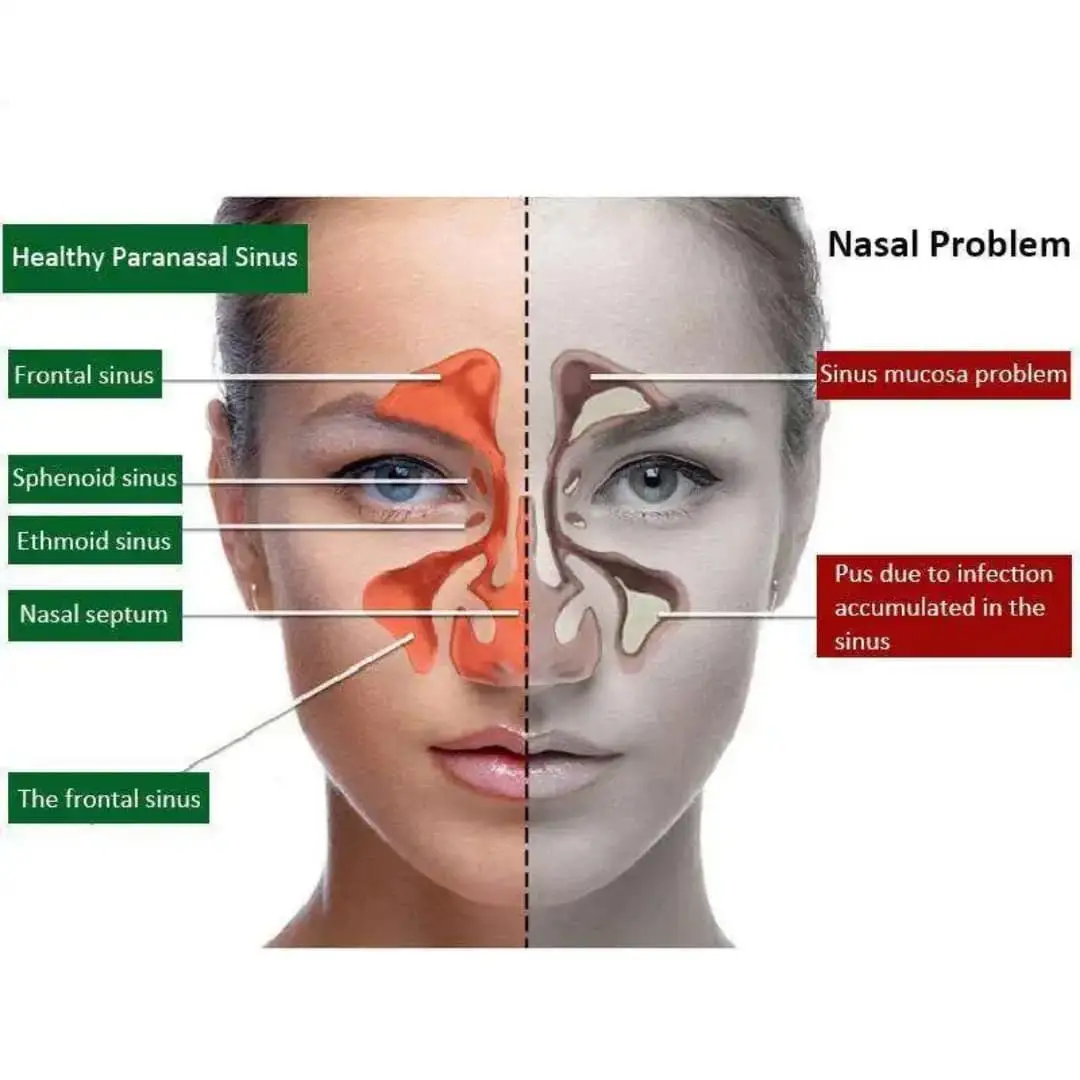 Vue alternative 3 - Spray Nasal ✨? PROMO EXCEPTIONNELLE ! ? Libérez votre respiration avec Nasal Spray HealMusz ?